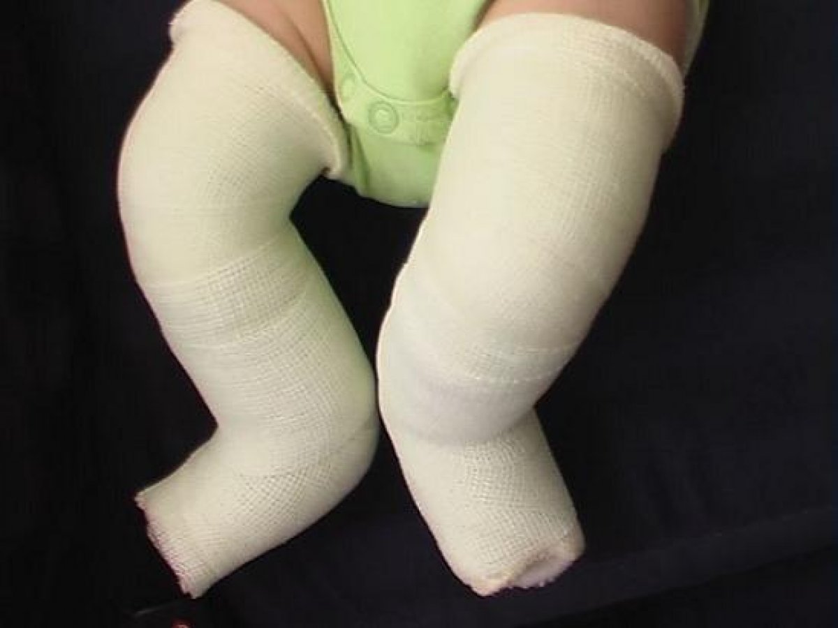 What is clubfoot #2