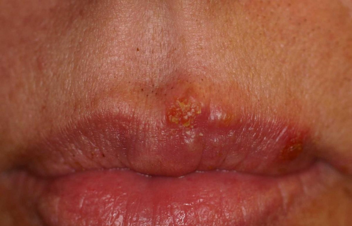 What is herpes simplex #2