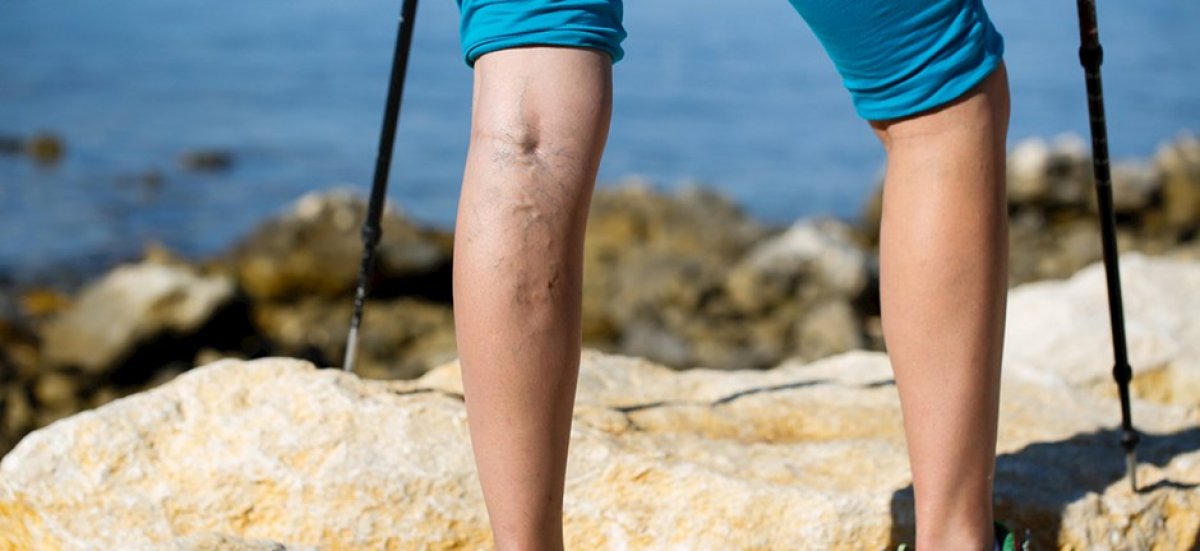 What is varicose veins #4