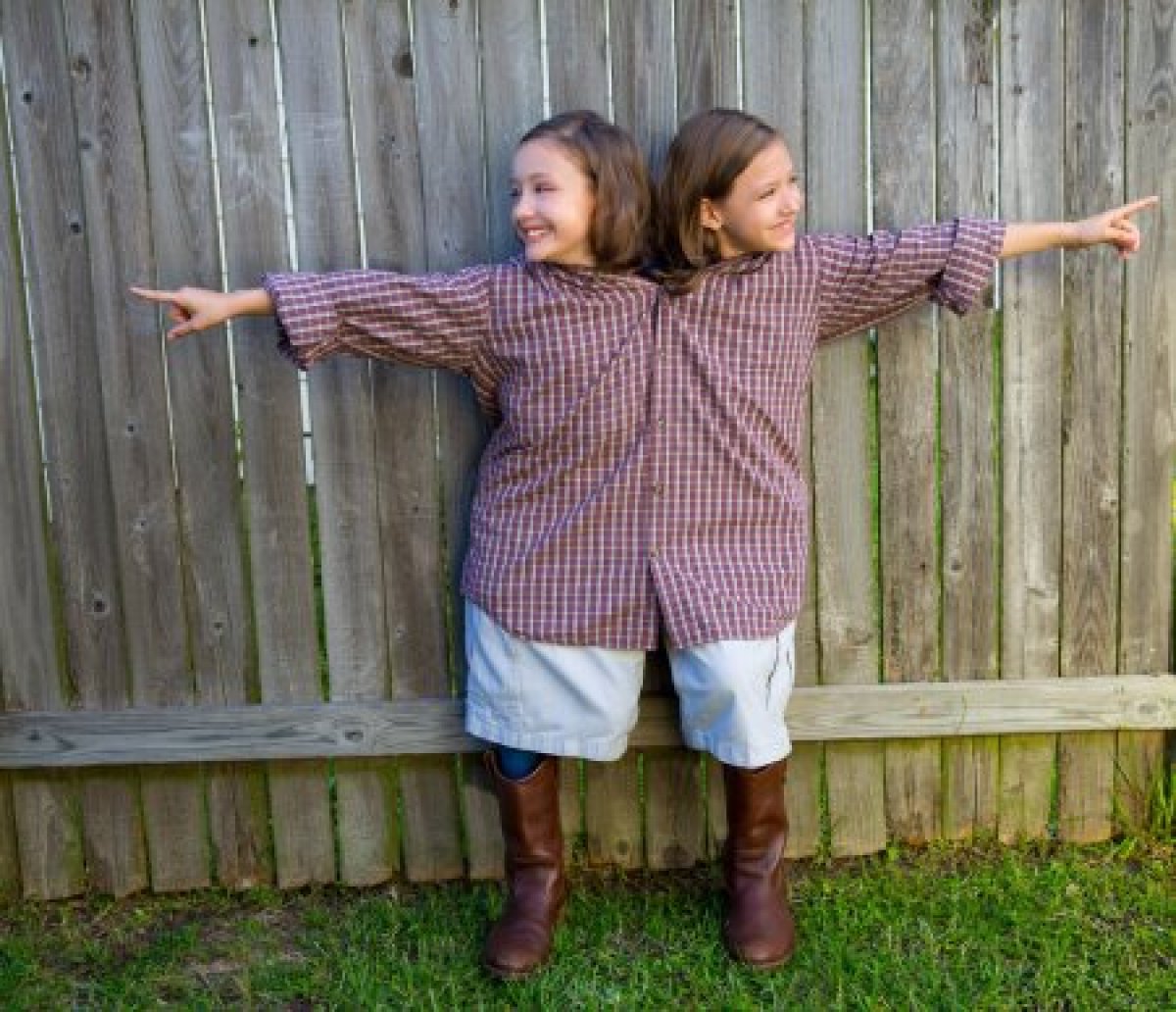 What is a Siamese twin #2