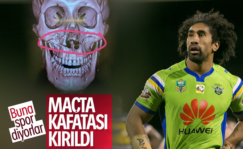 Rugby oyuncusunun kafatası ortadan kırıldı