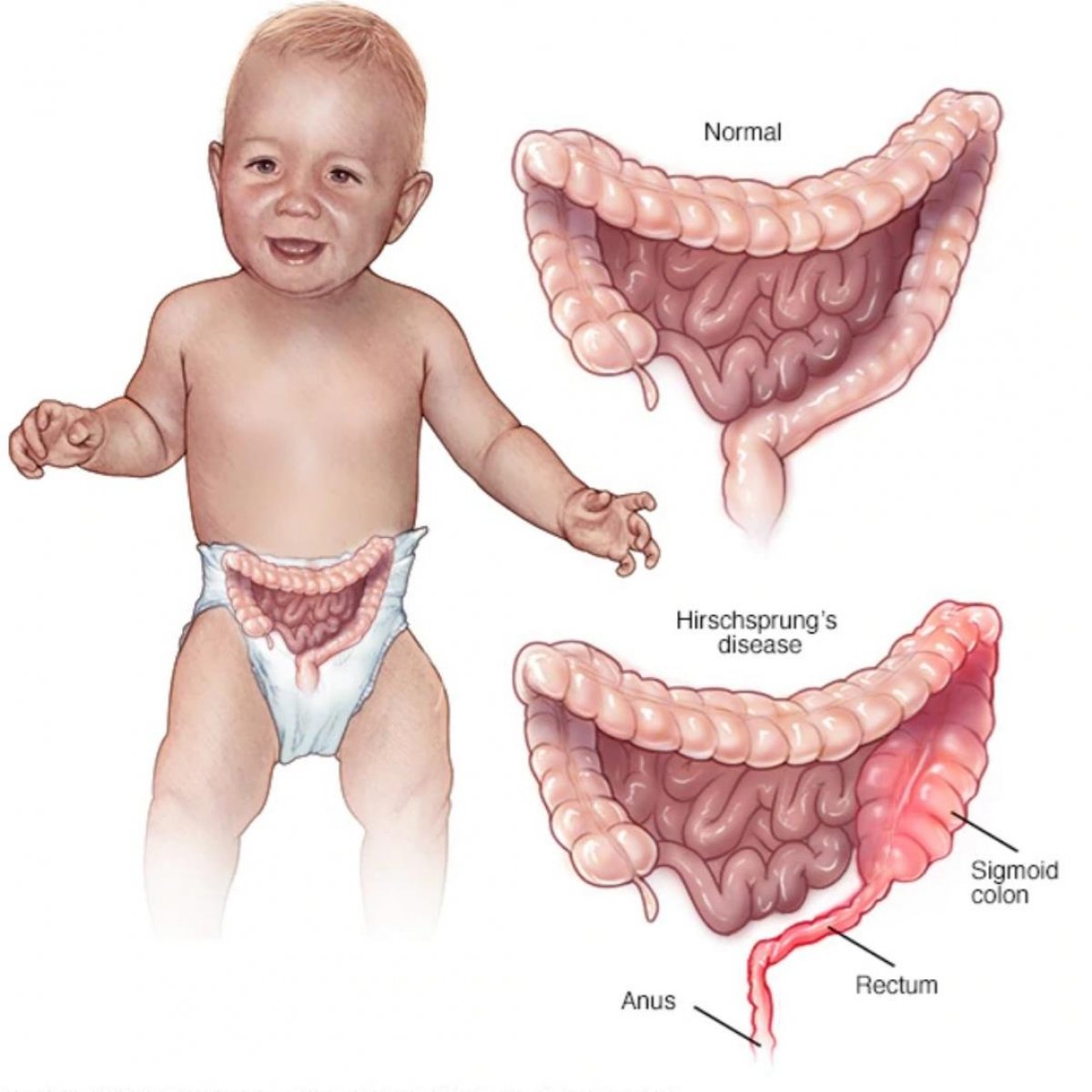 What is Hirschsprung's disease #2