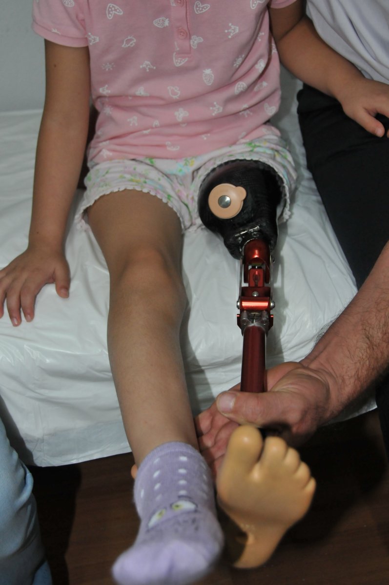 30 thousand TL is needed for the silicone prosthesis for Özge, whose leg was amputated in Antalya #2