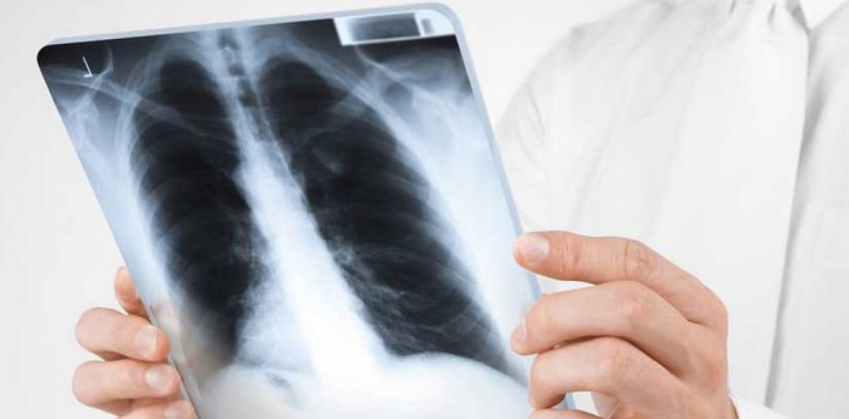 Early detection of insidious tuberculosis saves lives #3