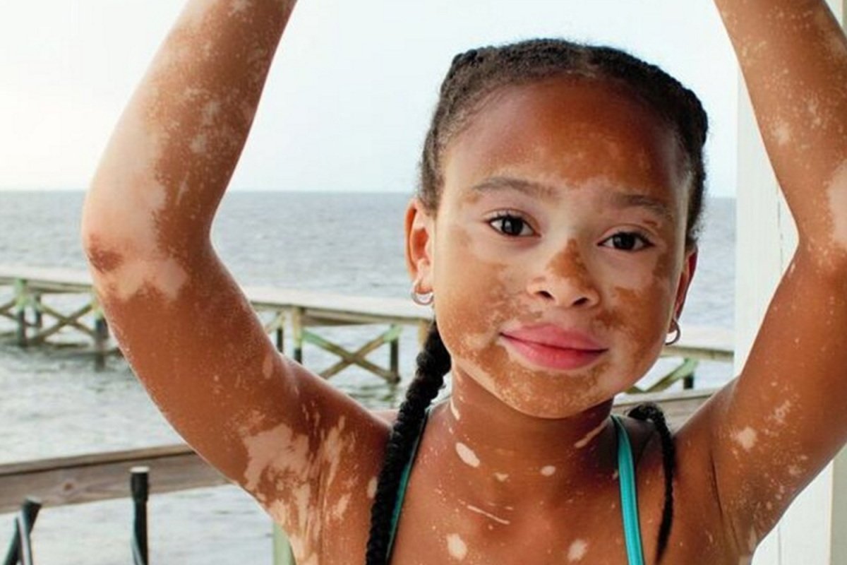 What is vitiligo, what are its symptoms?  Is vitiligo treatable or contagious?  #2nd