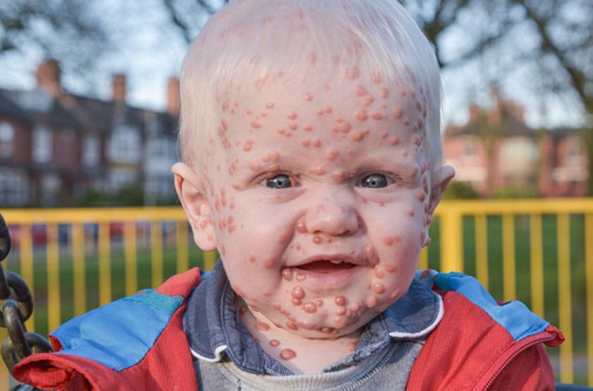 宝宝男孩儿出生25天了，身上起了小水泡，去儿童医院看了 说是水痘并发感染 这种并严重吗，有危险吗？急急 - 百度宝宝知道