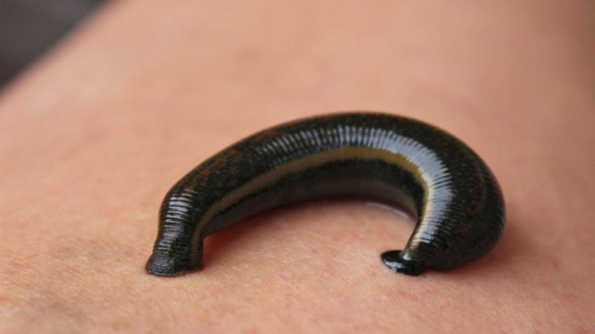 What is leech therapy and how is it done? What are the benefits of