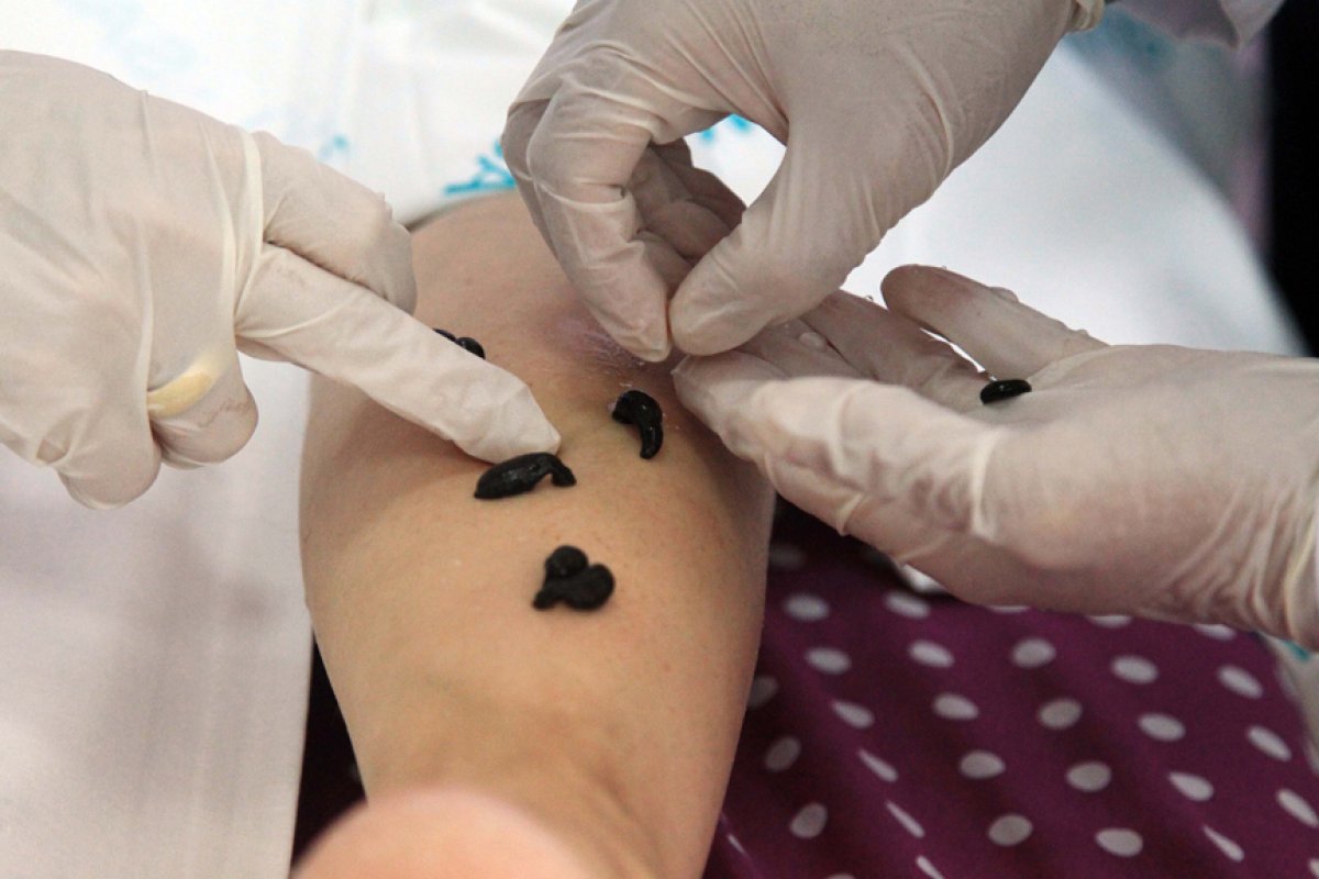 Sülük tedavisi nedir, nasıl yapılır? Sülük tedavisi faydaları nelerdir? Sülük tedavisi hakkında bilgiler.. #3