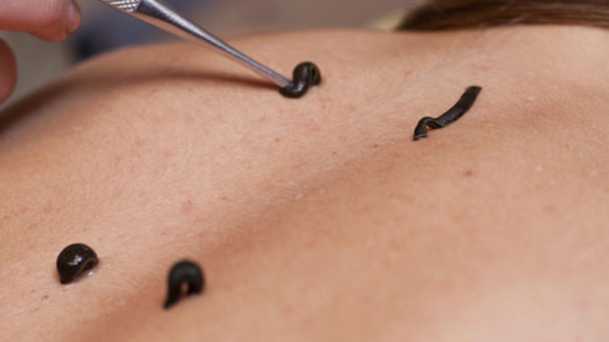 Sülük tedavisi nedir, nasıl yapılır? Sülük tedavisi faydaları nelerdir? Sülük tedavisi hakkında bilgiler.. #2