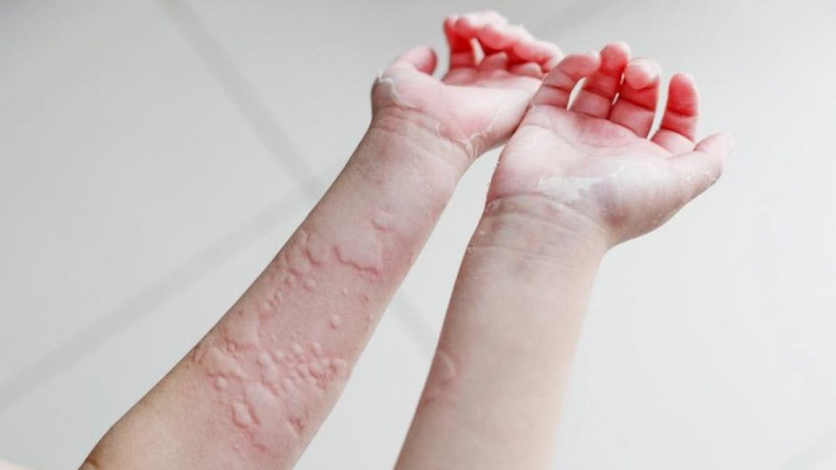 What is urticaria, what are its symptoms?  How does urticaria pass, what is its treatment?  #2nd