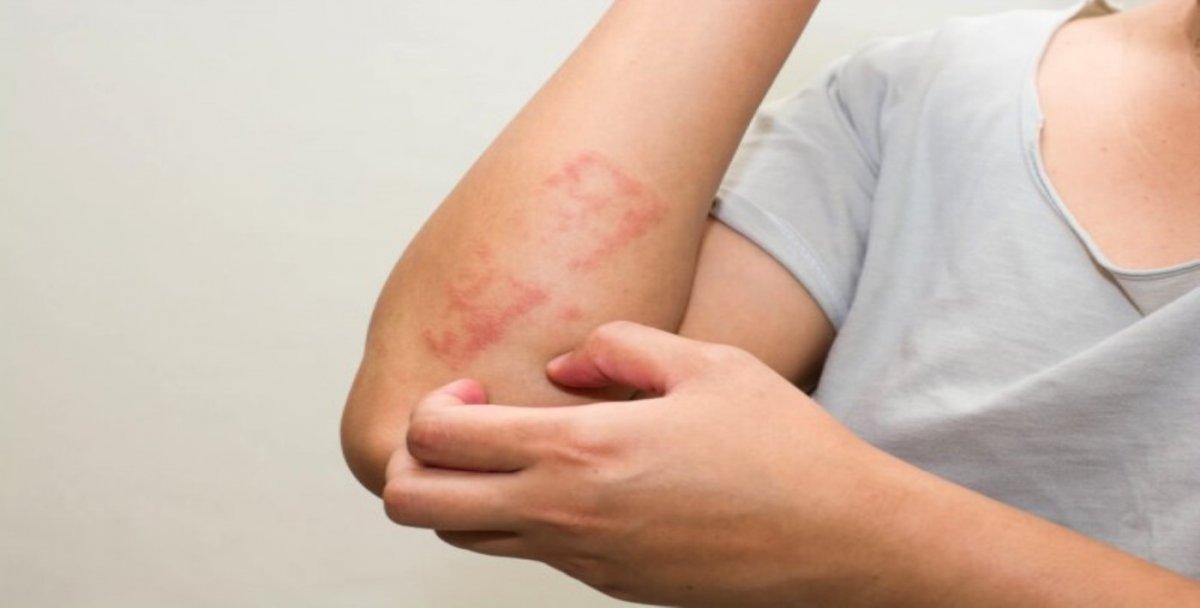 What is urticaria, what are its symptoms?  How does urticaria pass, what is its treatment?  #3
