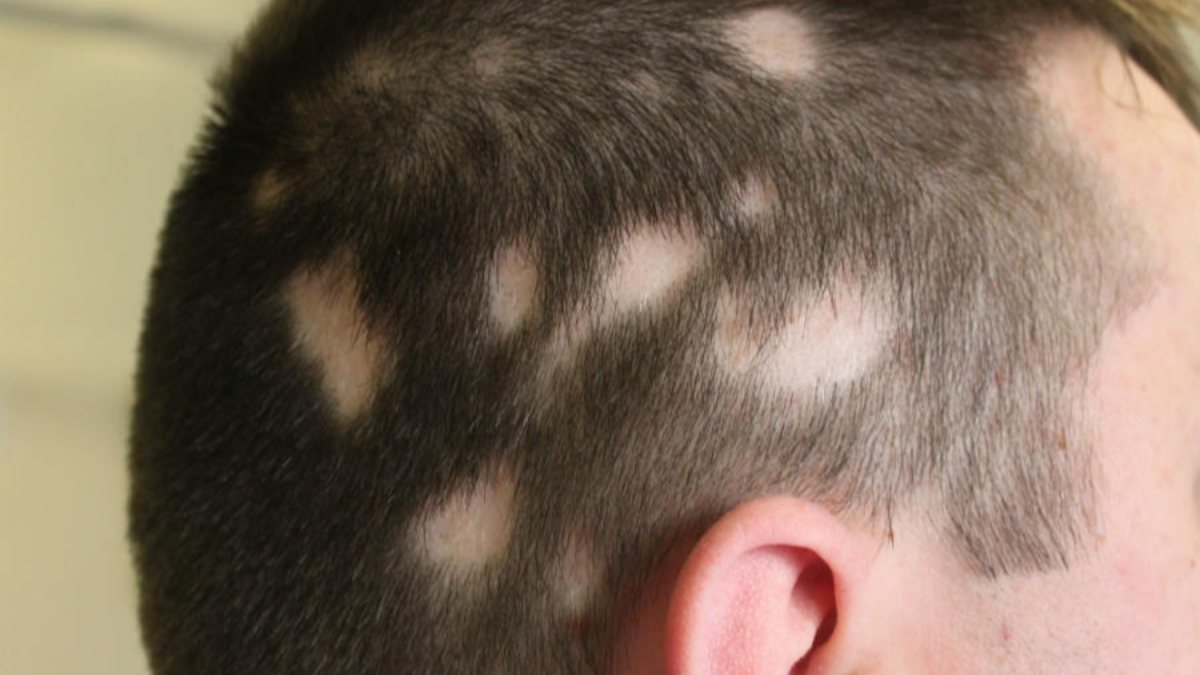 What is ringworm, what are its symptoms? How does ringworm go? Methods