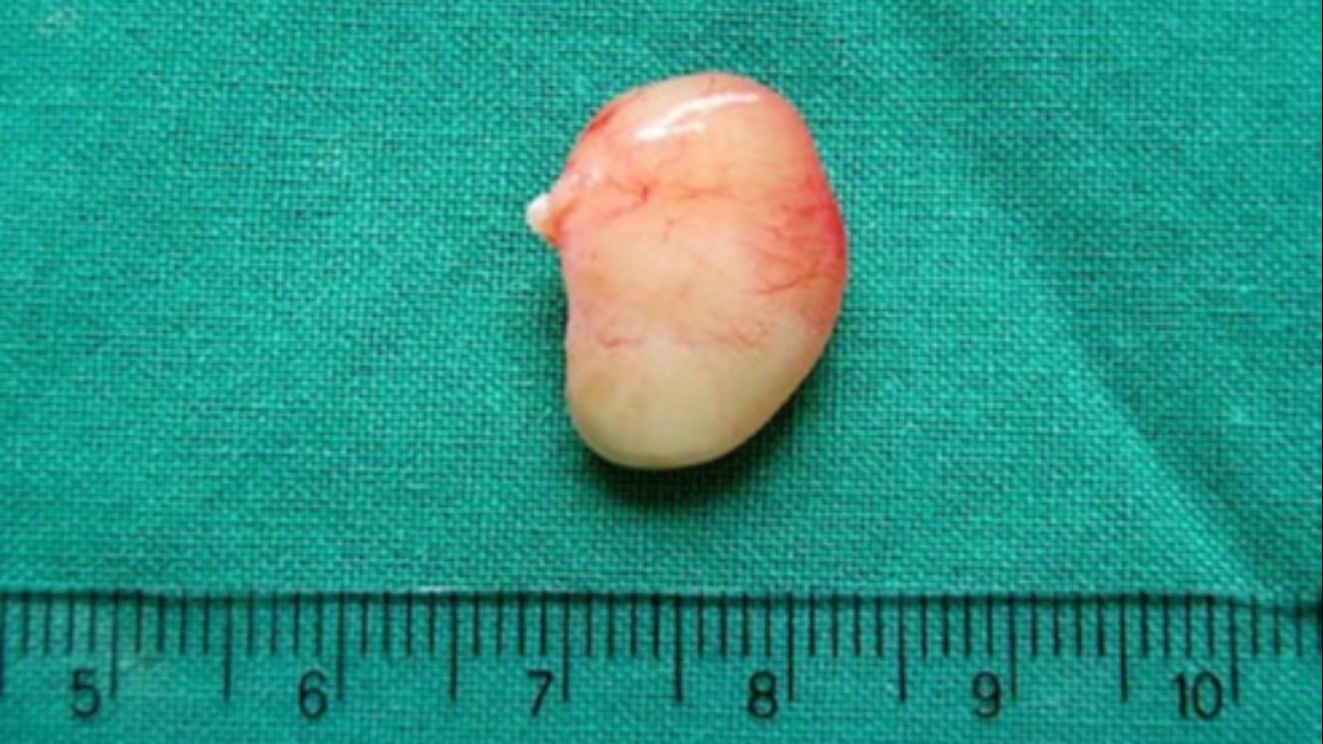 polip 3 mm