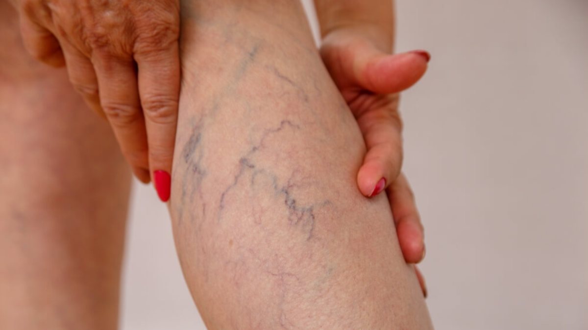 What is varicose veins and why does it occur? What is good for varicose