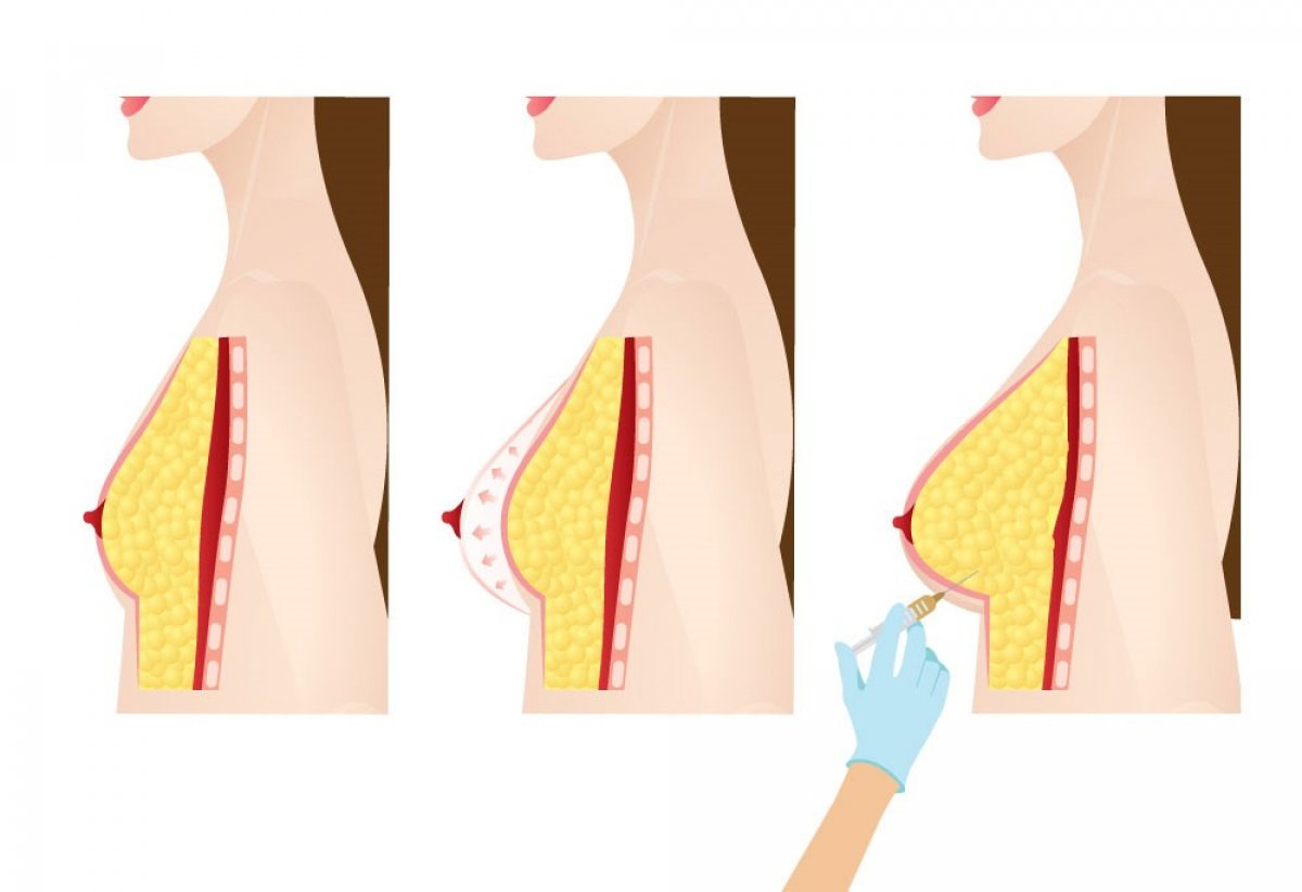 Breast augmentation is done not only with prosthesis, but also with fat injection into the breast #3