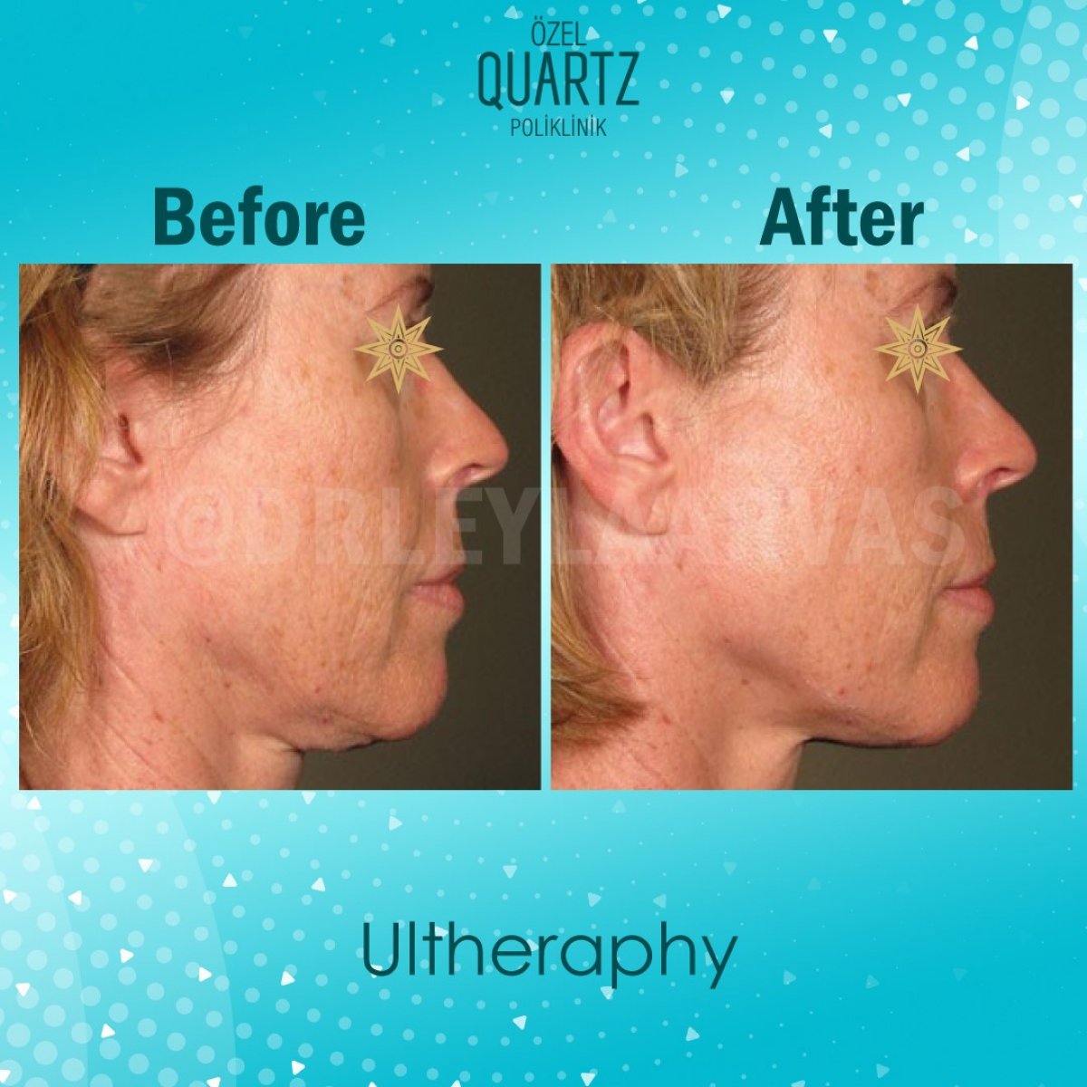 Non-Surgical Face Lift?  Of course it's possible #2