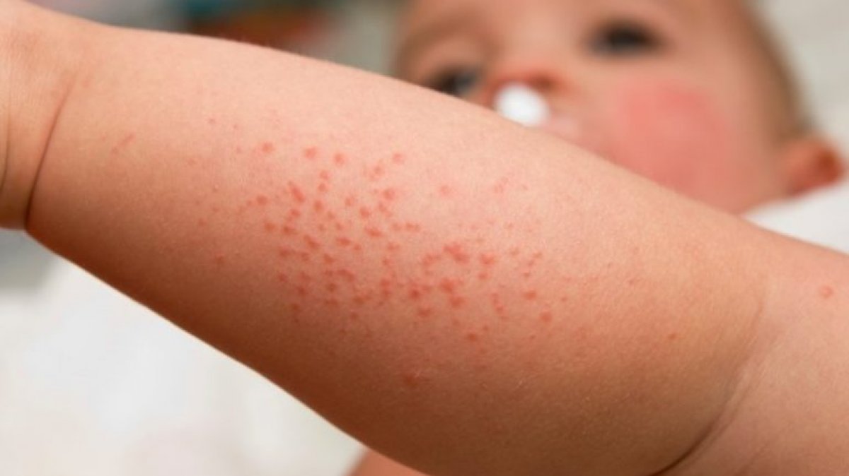 Beware of foods that trigger eczema in babies #3