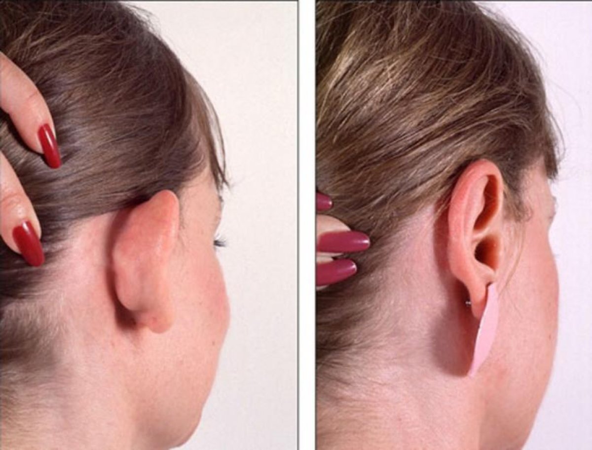 How to understand prominent ear, can it be fixed?  How is prominent ear surgery (Otoplasty) performed?  #3