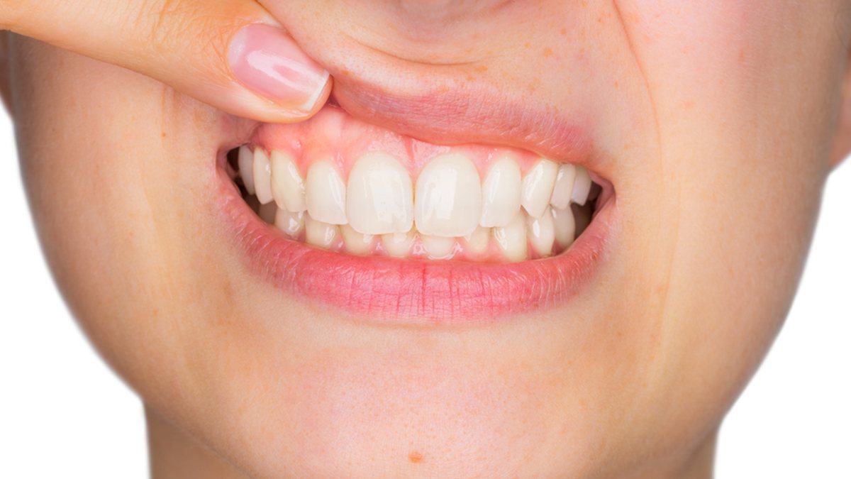6 signs of too much plaque buildup on the tooth Kimdeyir