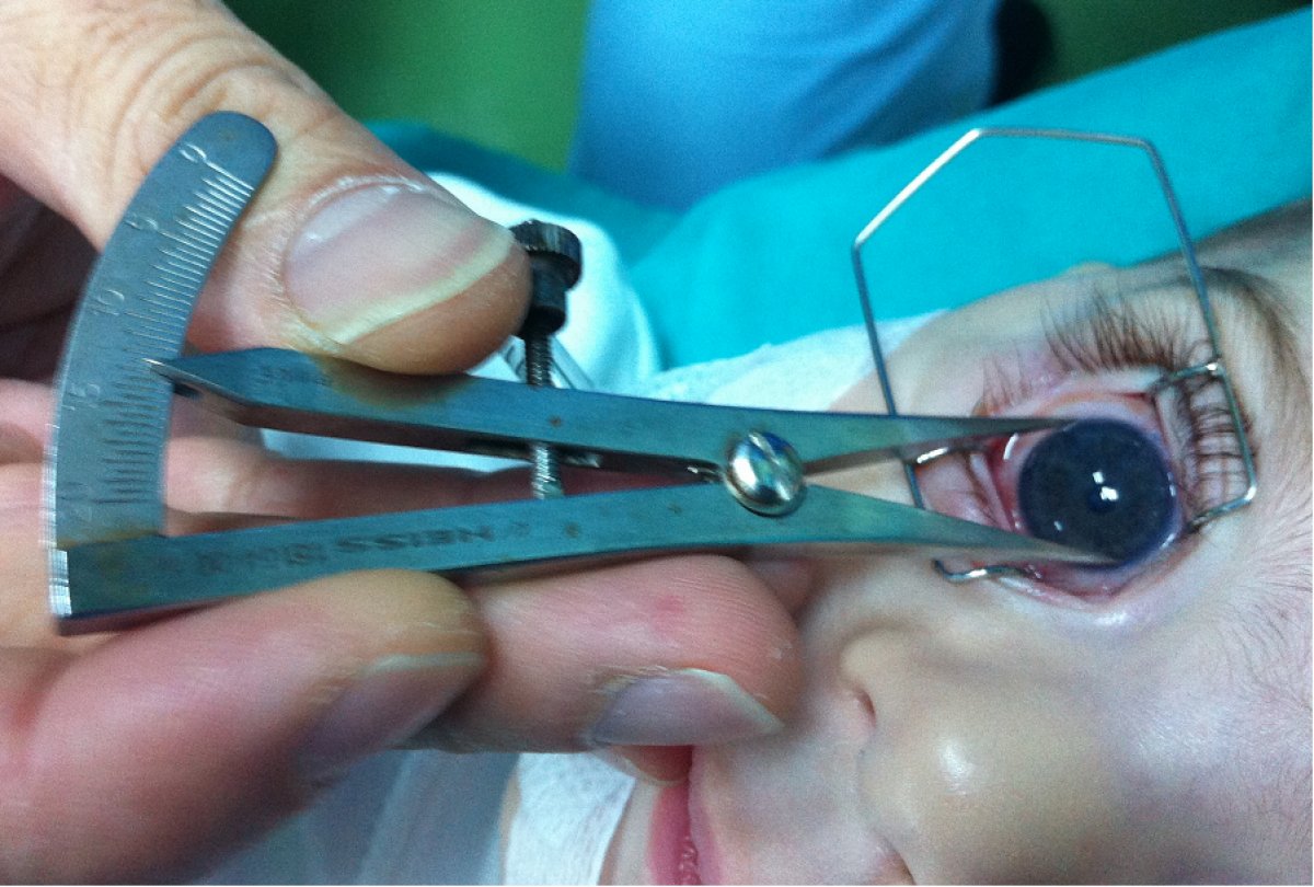 What is congenital glaucoma, what are its symptoms?  Is there a treatment for congenital glaucoma?  #2nd