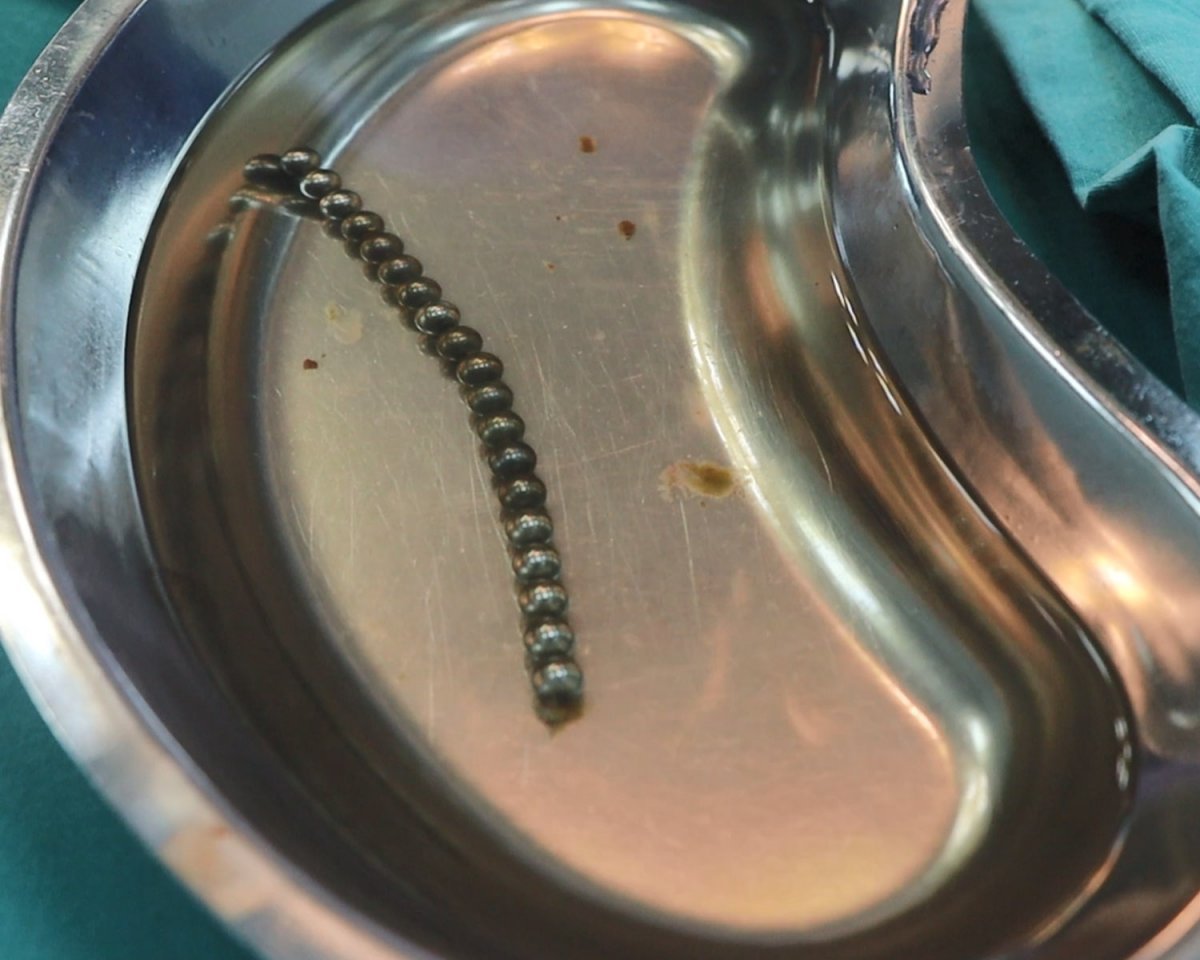 A 4.5-year-old boy in Istanbul swallowed 19 magnets #2
