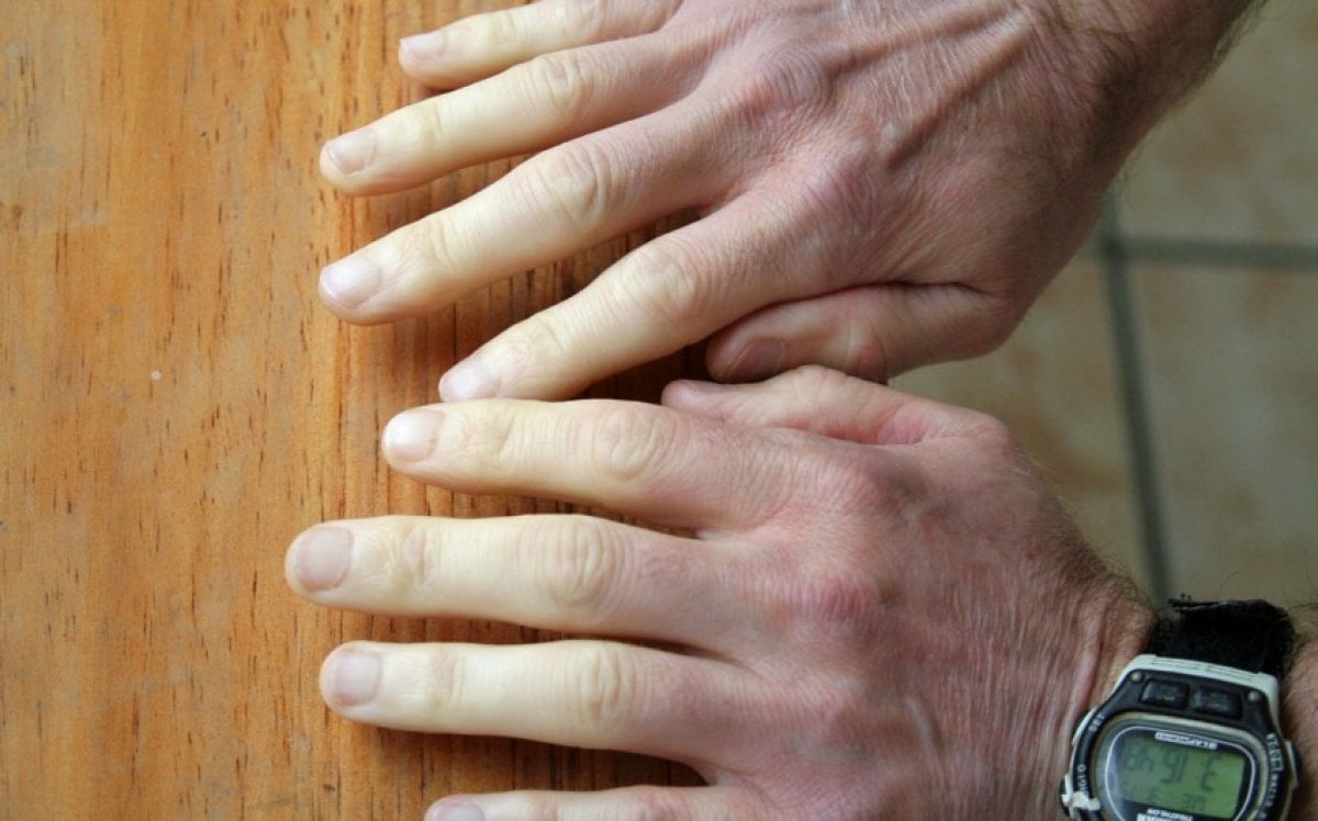 White finger disease: What is Raynaud's syndrome?  What are the symptoms of Raynaud's (Reyno) syndrome?  #2nd