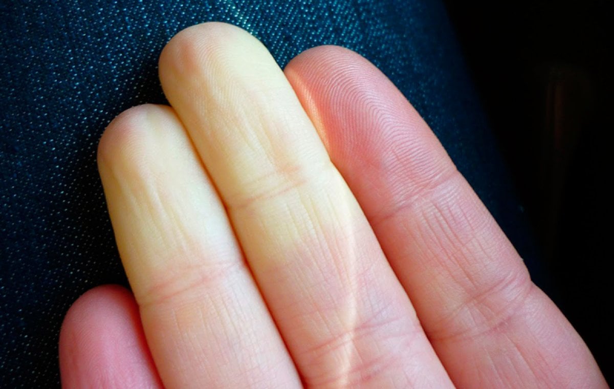 White finger disease: What is Raynaud's syndrome?  What are the symptoms of Raynaud's (Reyno) syndrome?  #3