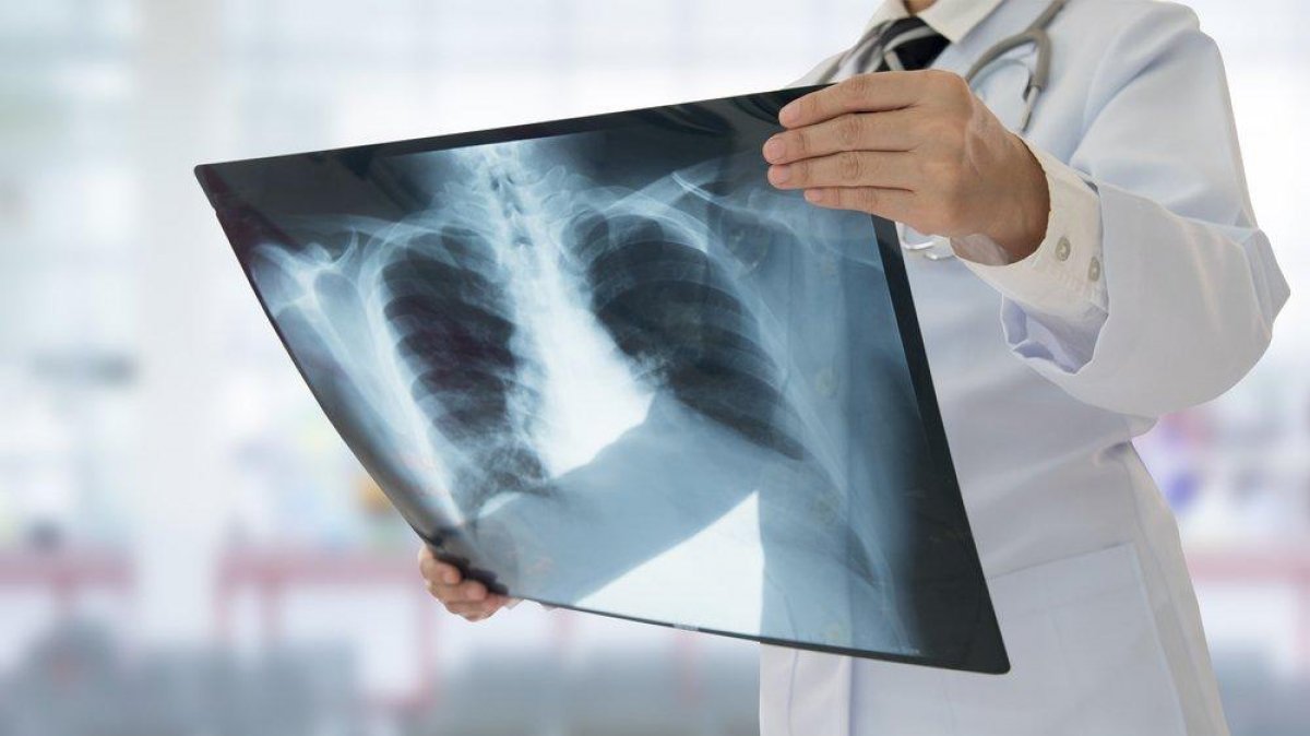 24 March World Tuberculosis Day: What is tuberculosis, what are its symptoms?  #2nd