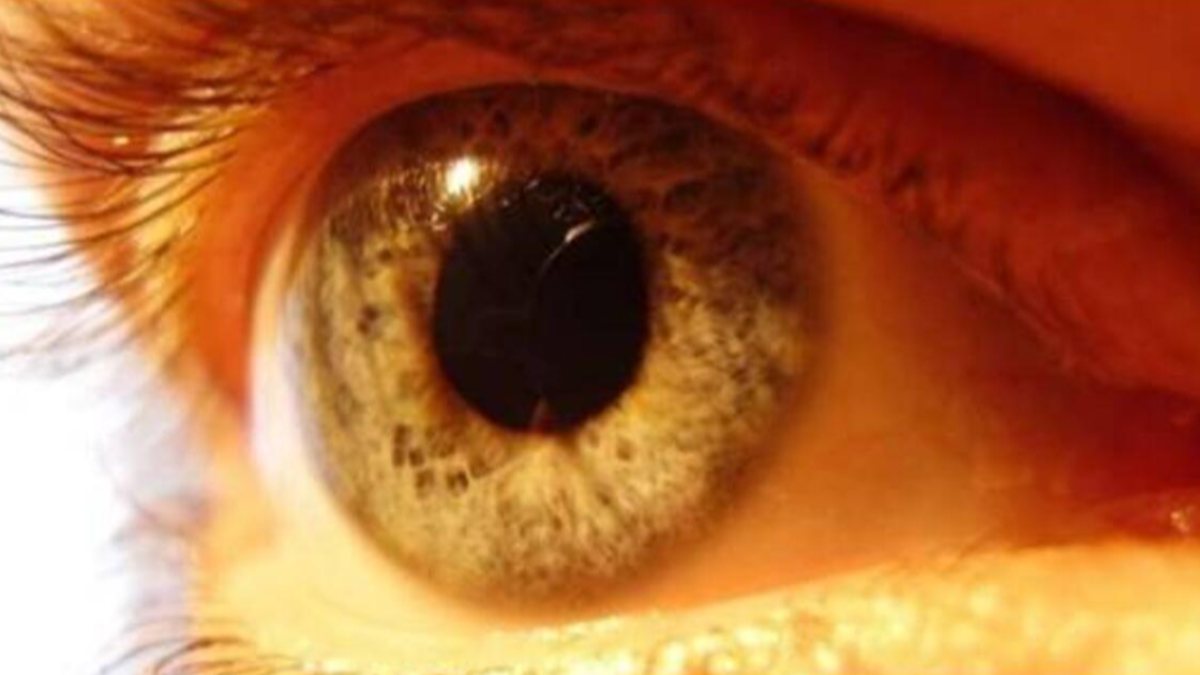 Yellow spot disease can lead to permanent vision loss Kimdeyir
