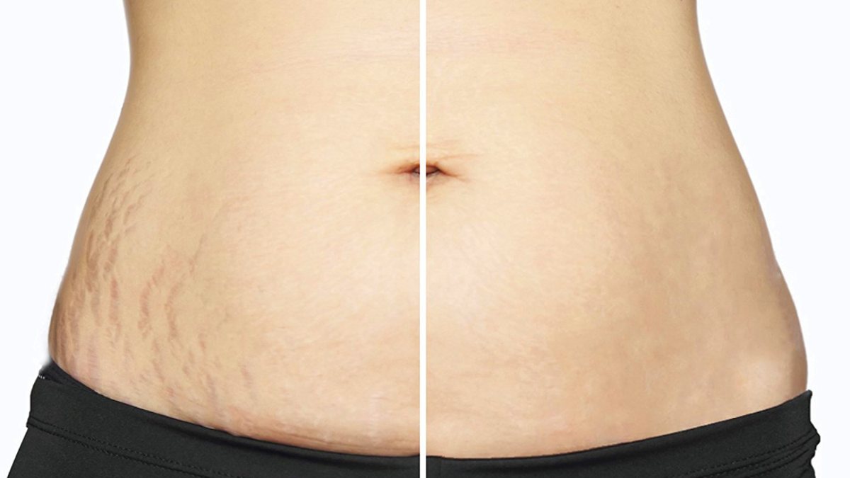 6 ways to make your stretch marks less visible Kimdeyir