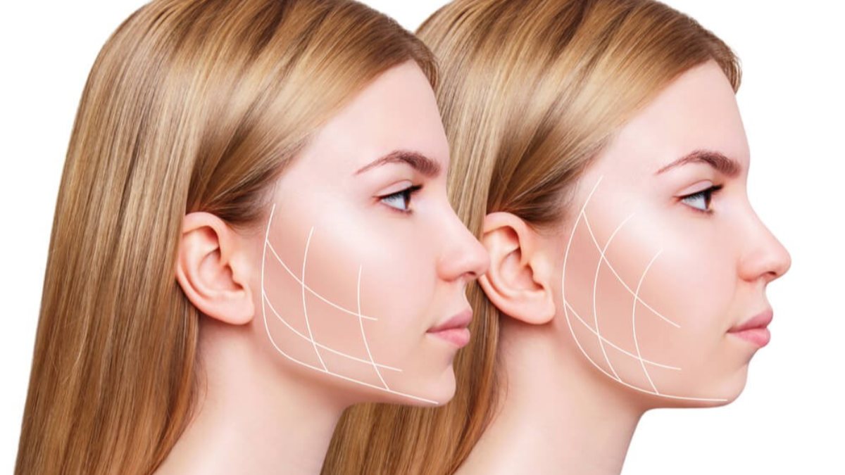 Applications Reshaping The Jaw Line Botox And Jawline Fillers Kimdeyir