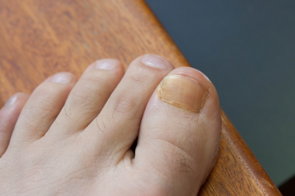 10 things your feet reveal about your health #8