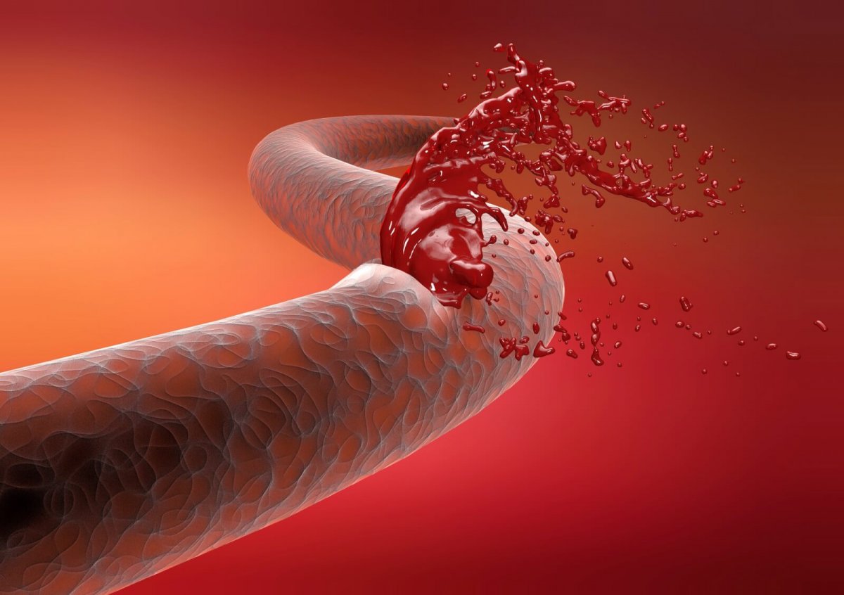 8 signs of blood clotting that you should not ignore #9