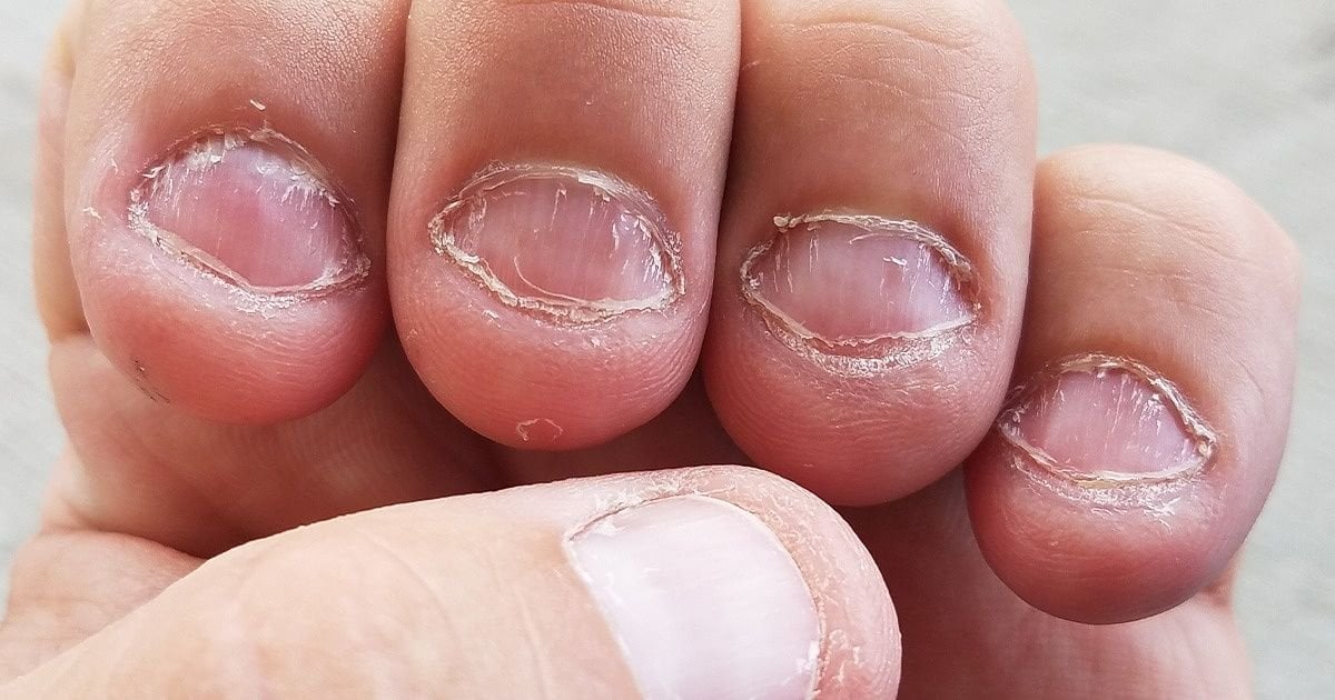 Nail biting disease: What is onychophagia?  It invites Covid-19. #2