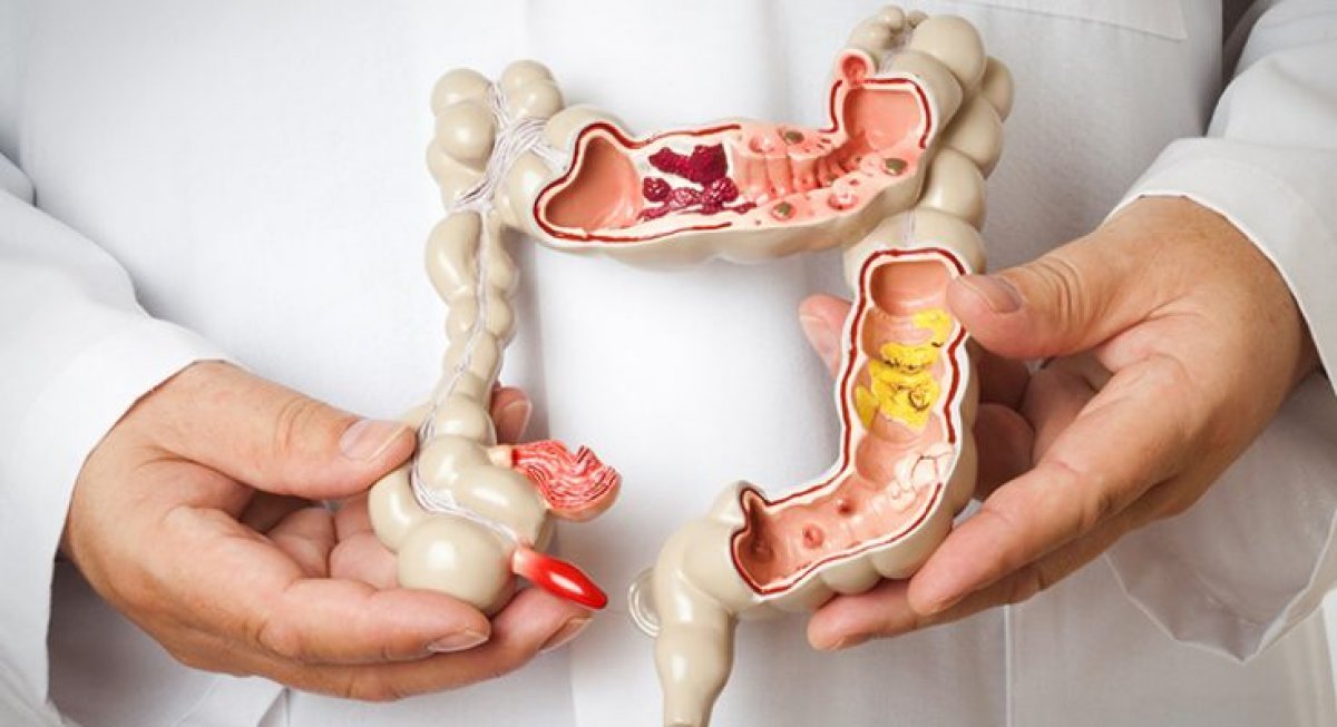 Bensu Soral'ın hastalığı Crohn nedir? Crohn hastalığı belirtileri nelerdir?