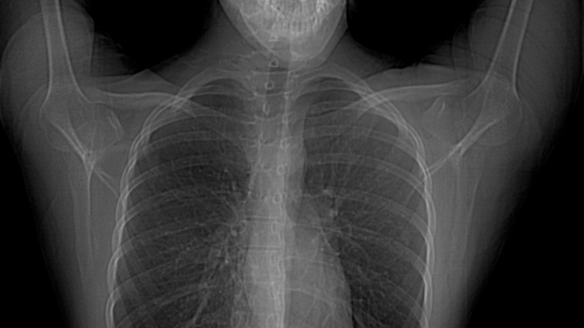 Deformity of the chest wall What is Poland syndrome? Kimdeyir