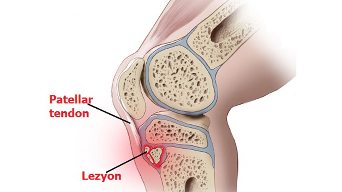 Patellar tendon yırtığı nedir, ne zaman düzelir? Patellar tendon yırtığı tedavisi..