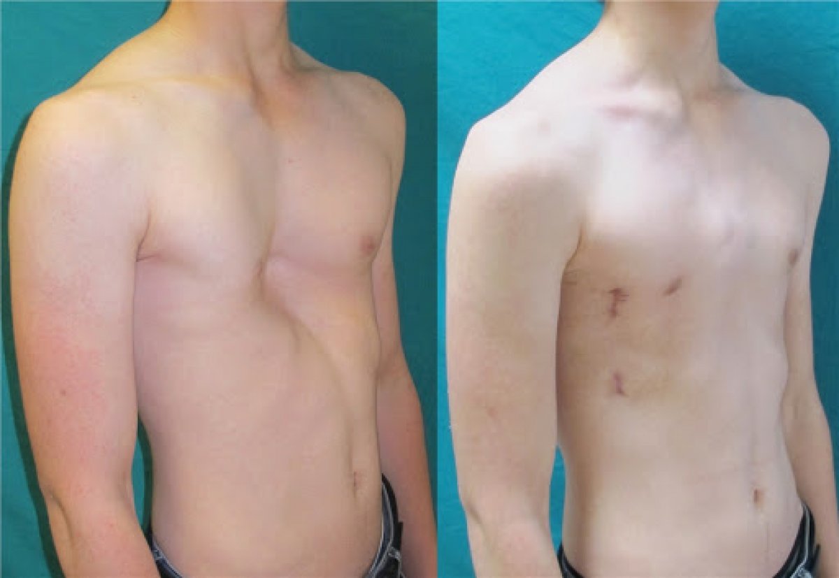 Deformity of the chest wall: What is Poland syndrome?  #3