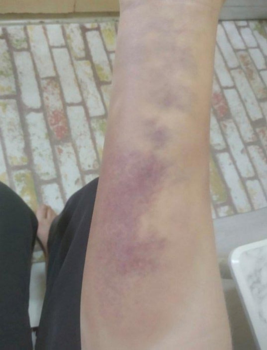 İzmir'de sevgiliye beyzbol sopasıyla şiddet: İddianame hazırlandı