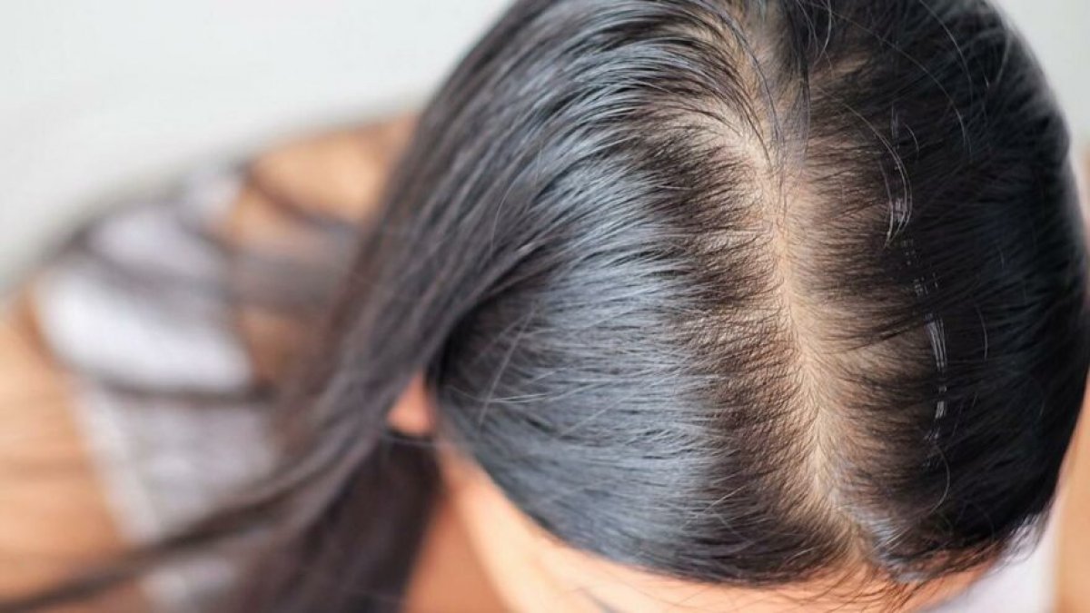 Hair loss may be caused by Covid-19 #3