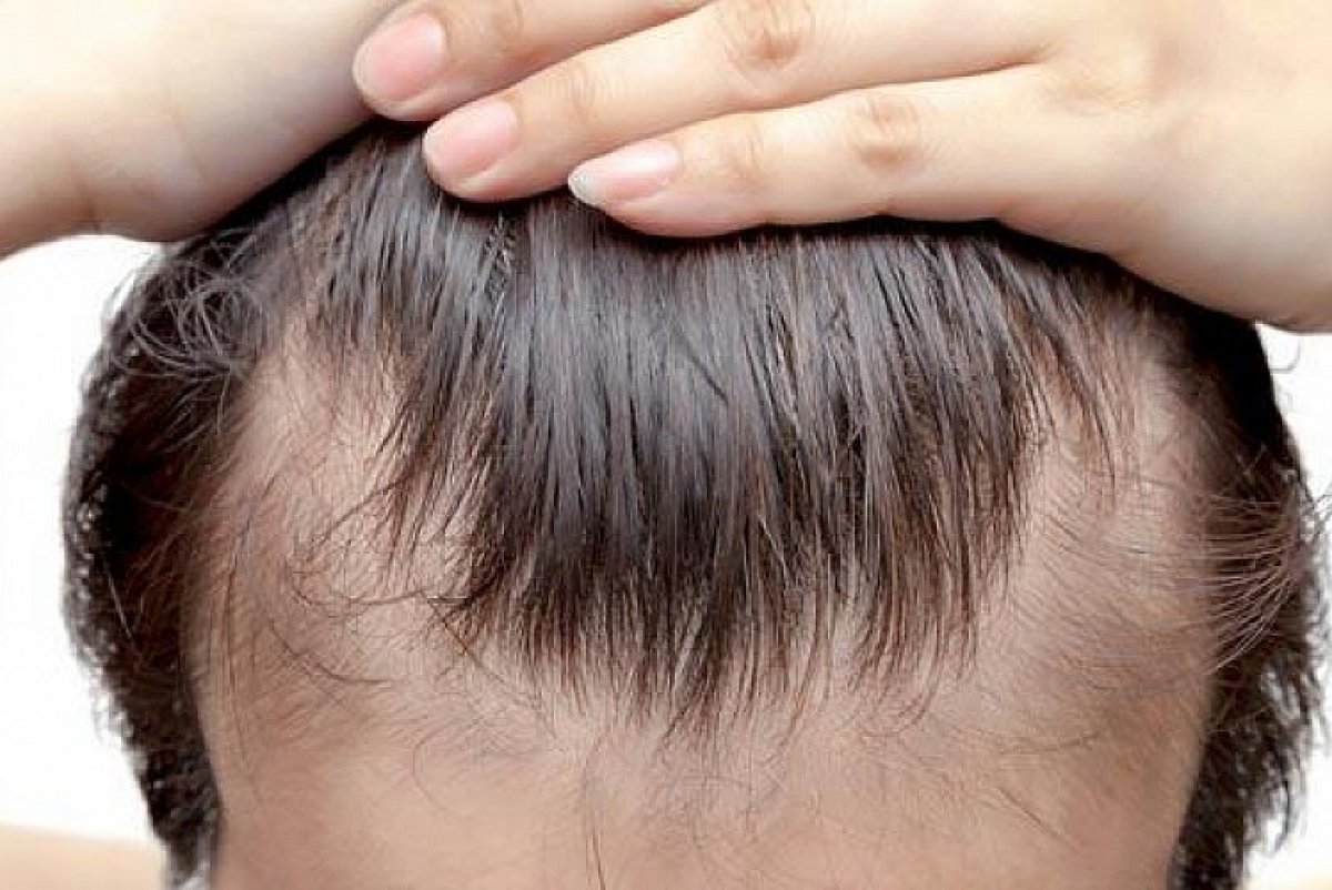 Hair loss may be caused by Covid-19 #2