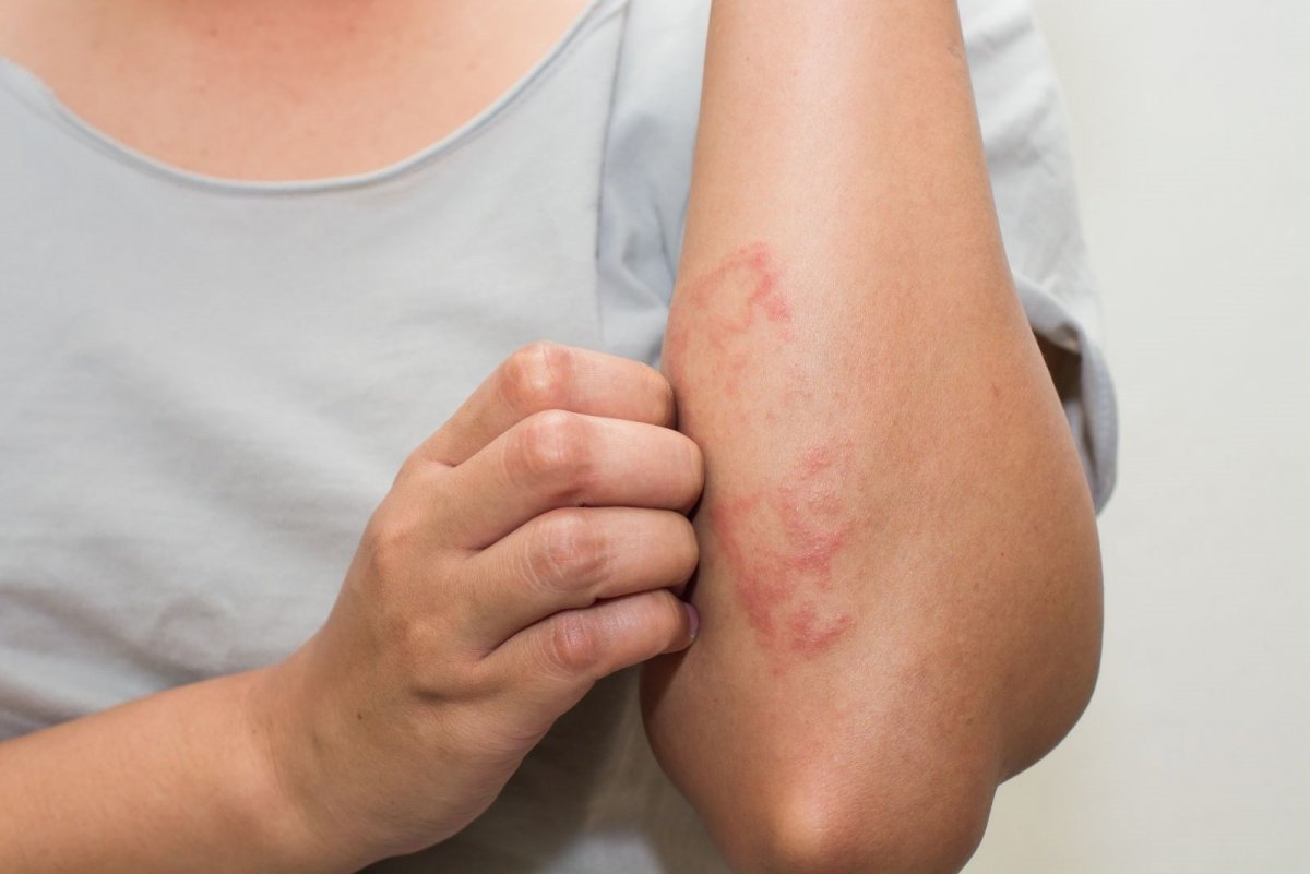 Is itching and rash a sign of Covid-19?  Skin symptoms of coronavirus #2