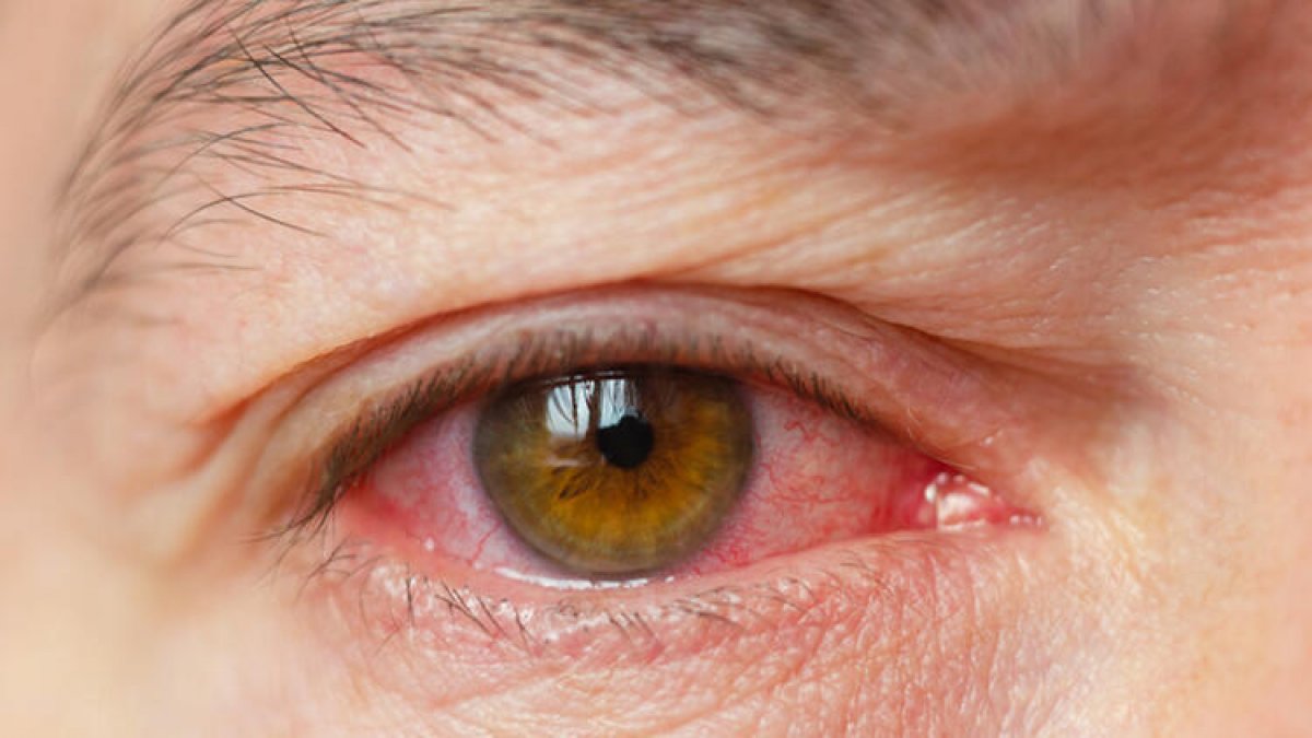 6 eye problems increasing due to the pandemic #4