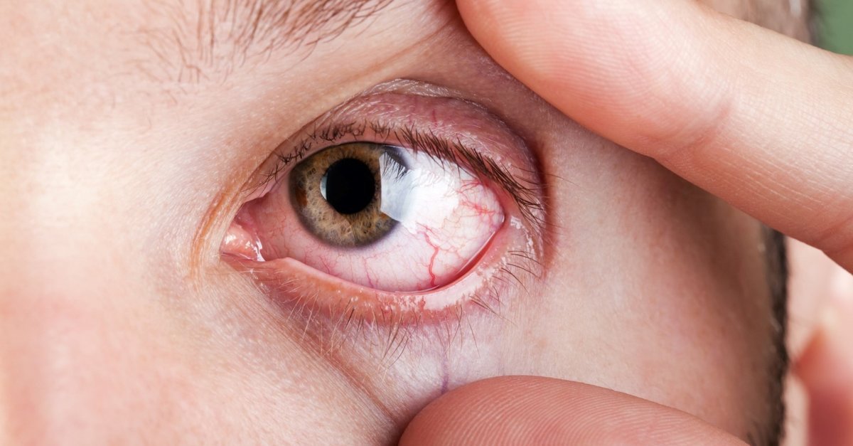 6 eye problems increasing due to the pandemic #5