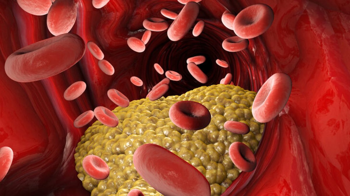 What is triglyceride #2