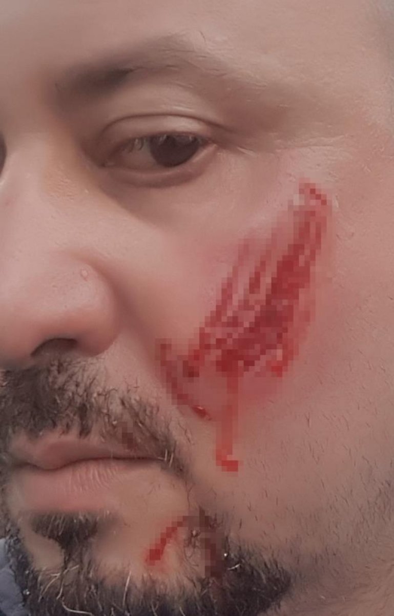 Bursa da, avukatın yanağını ısıran kişiye ceza  #1