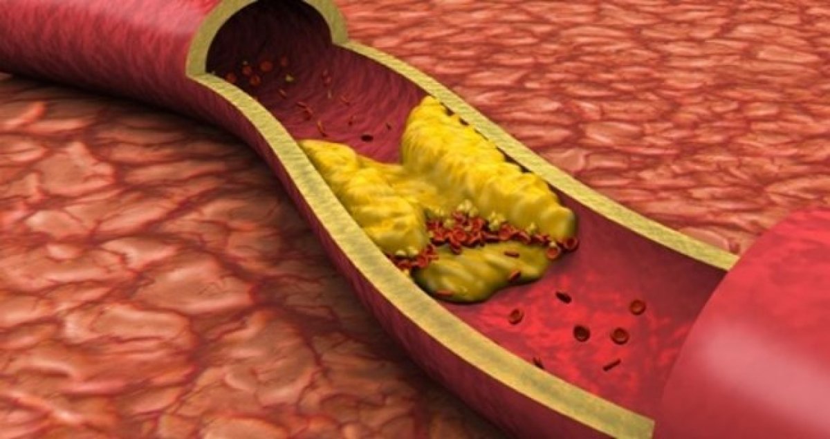 What is atherosclerosis #2