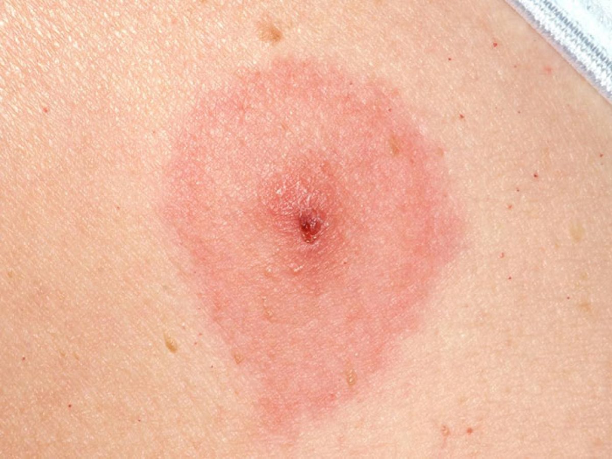 tick bite rash pictures