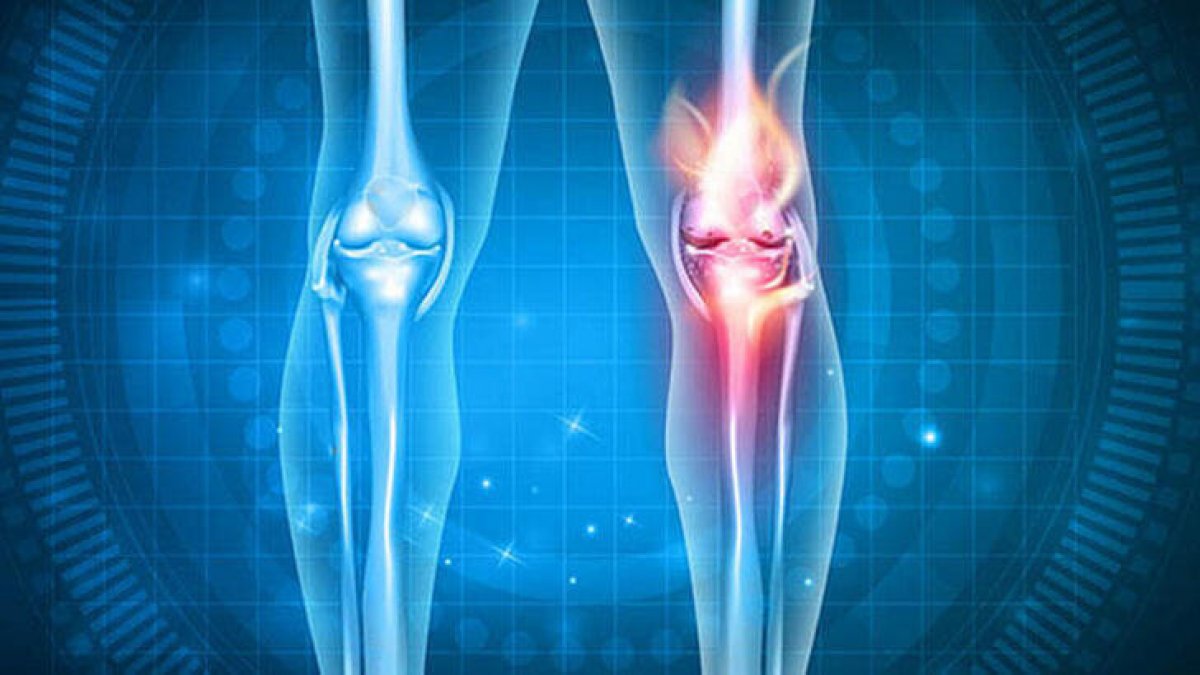 Silent disease that weakens bones: Osteoporosis #4