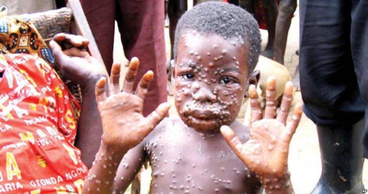 New epidemic in Europe: What is the monkeypox virus, what are the symptoms?  #2nd